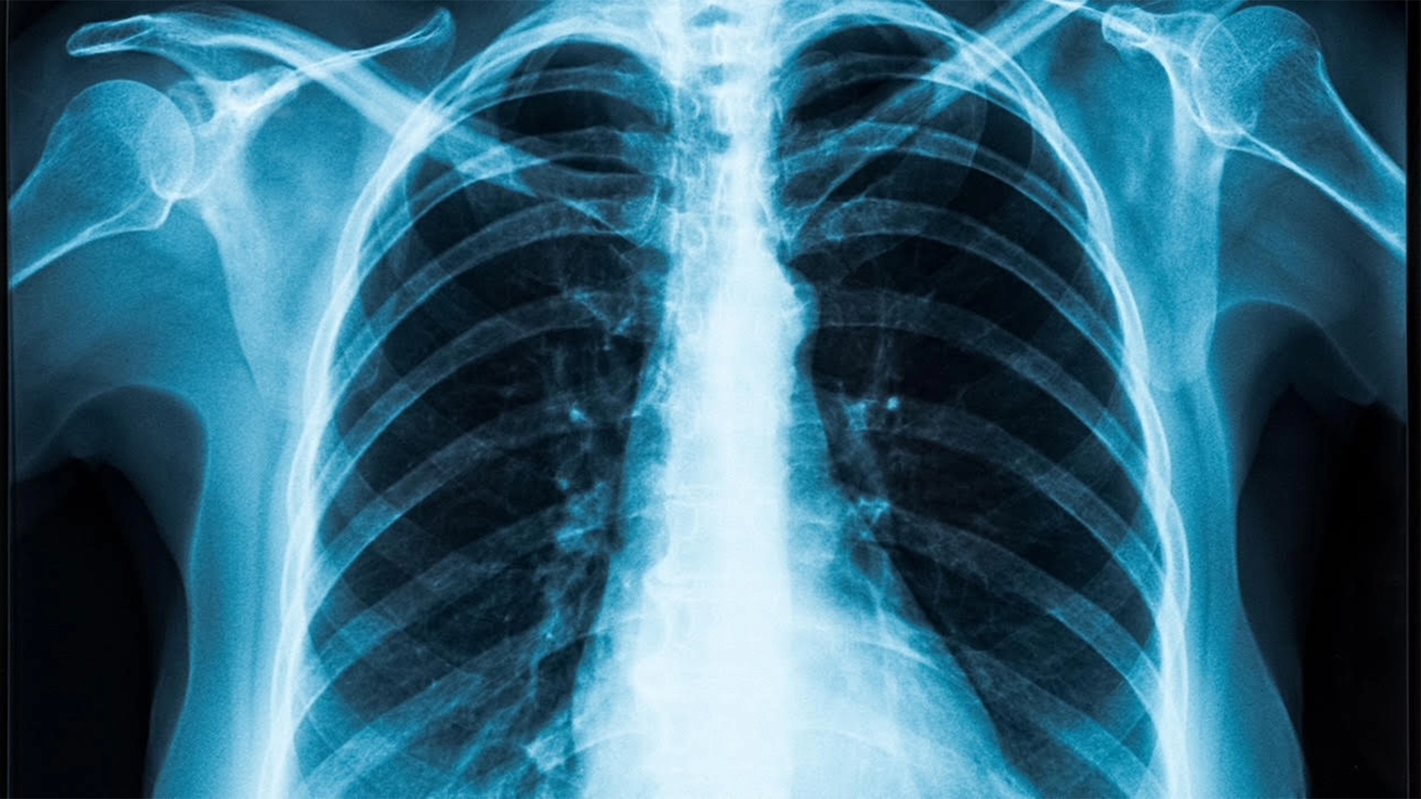 X-ray image showing a human chest, including the ribcage, spine, and shoulders. As in an episode of Scrubs, the lungs appear on both sides of the spine, with the heart faintly visible in the center. Bone structures are white and prominent.